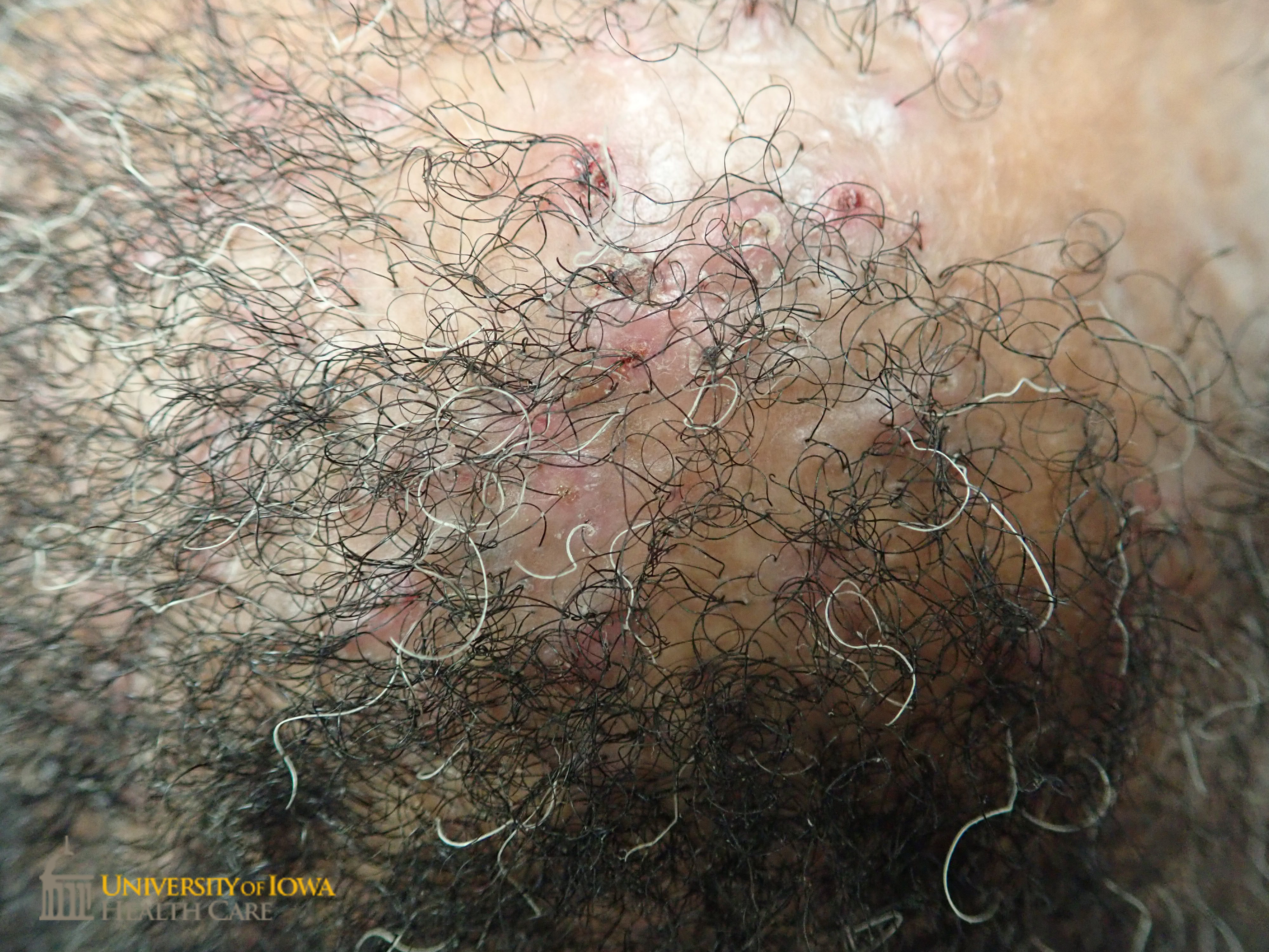 Follicularly based papules and pustules surrounded by a patch of scarring alopecia on the scalp . (click images for higher resolution).